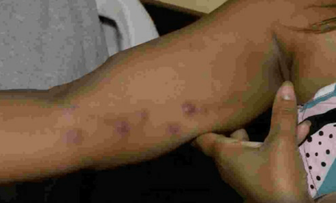 Mais de 140 casos de esporotricose em humanos foram registrados em Pernambuco em 2017 e 2018 - Foto: Reprodução/TV Jornal