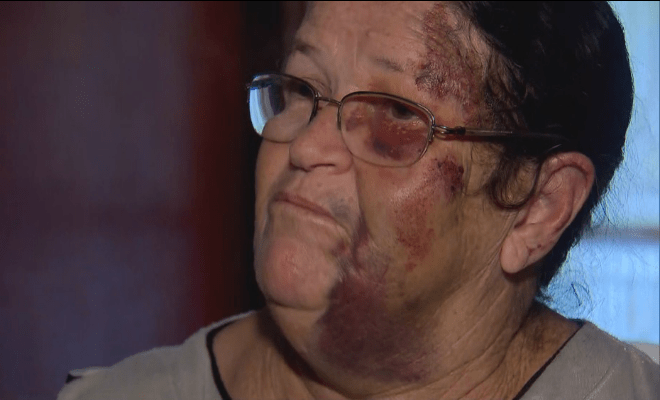 A vendedora de balões Marina Izidoro de Morais ficou com diversos hematomas pelo corpo após ser arrastada por carro no Distrito Federal — Foto: TV Globo/Reprodução 