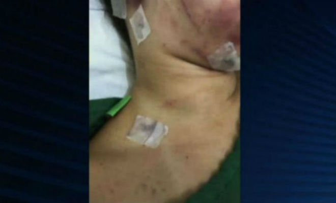 O agressor agrediu e perfurou várias partes do corpo da pernambucana | Foto: Reprodução/ TV Jornal