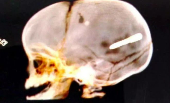 Bebê foi atingido na terça-feira por peça de obra. Médicos não conseguiram retirar objeto, que atingiu o cérebro da criança Foto: Reprodução 
